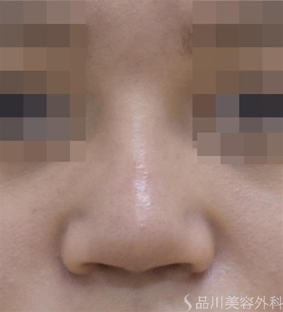 症例NO.46180のAFTER写真