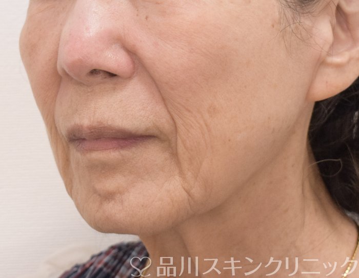 症例NO.73426のBEFORE写真