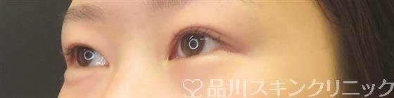 症例NO.59158のBEFORE写真