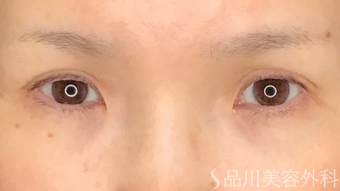 症例NO.64750のBEFORE写真