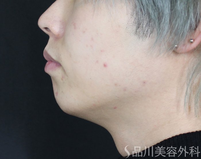 症例NO.71958のBEFORE写真