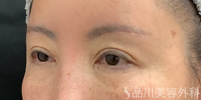 症例NO.73319のAFTER写真