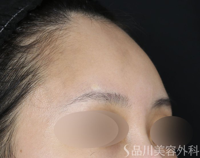 症例NO.70836のBEFORE写真