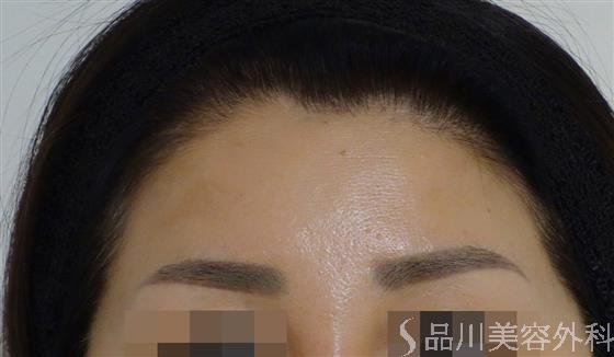 症例NO.49464のAFTER写真