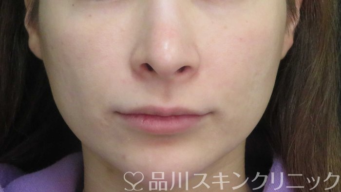 症例NO.71198のBEFORE写真