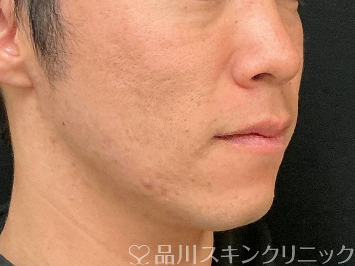 症例NO.74786のAFTER写真