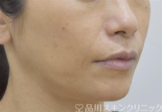 症例NO.53406のAFTER写真