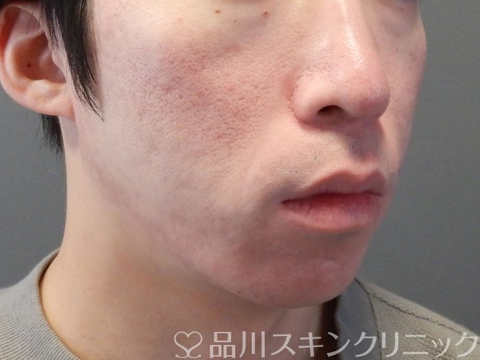 症例NO.70426のAFTER写真