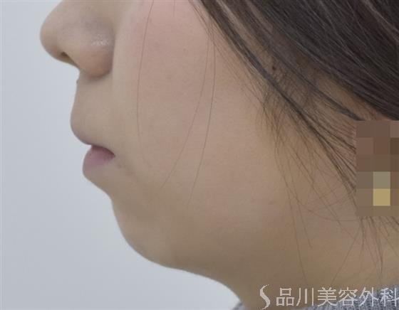 症例NO.46845のBEFORE写真