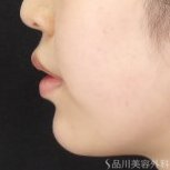 症例NO.74365のAFTER写真