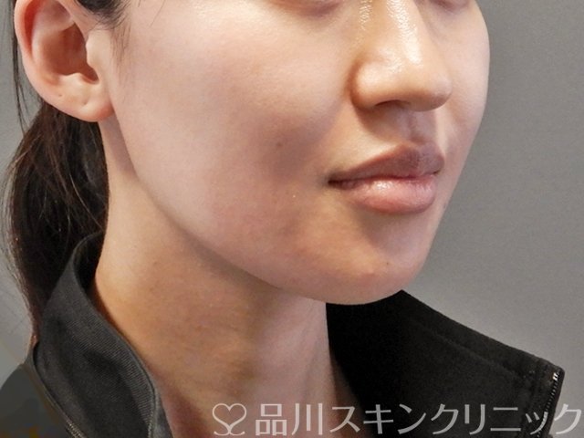 症例NO.64384のBEFORE写真