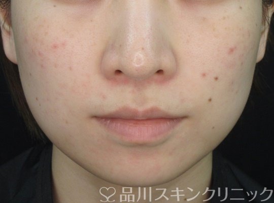 症例NO.70265のAFTER写真