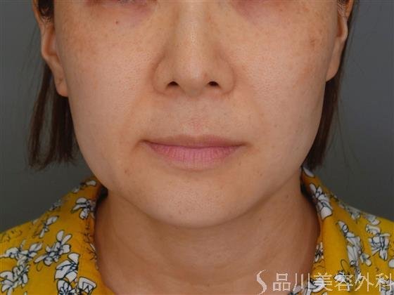 症例NO.51282のBEFORE写真