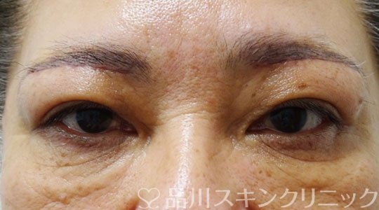 症例NO.69407のAFTER写真