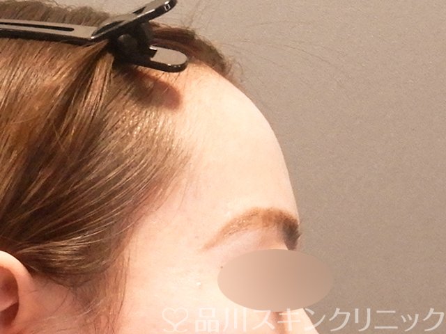 症例NO.70114のBEFORE写真