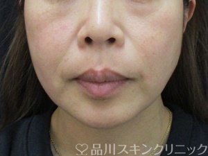 症例NO.74285のBEFORE写真