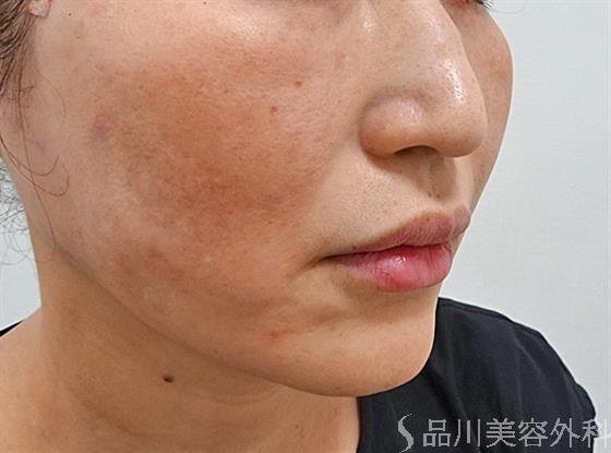 症例NO.61834のAFTER写真