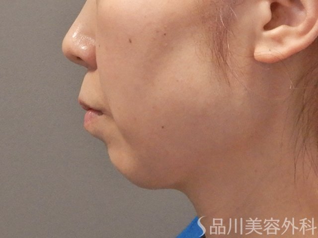症例NO.74137のBEFORE写真