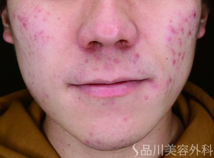 症例NO.72744のBEFORE写真