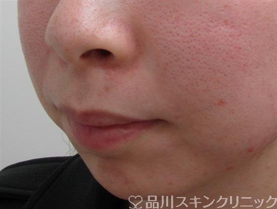 症例NO.34648のBEFORE写真