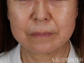 症例NO.71909のBEFORE写真