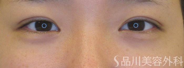 症例NO.72118のAFTER写真