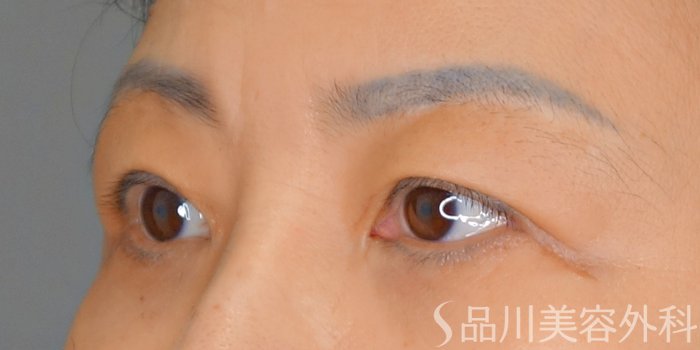 症例NO.70655のBEFORE写真