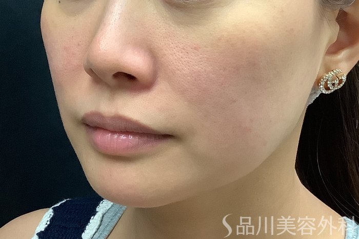 症例NO.71581のBEFORE写真