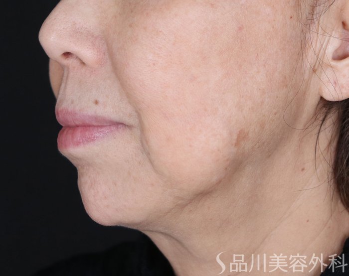 症例NO.72388のBEFORE写真