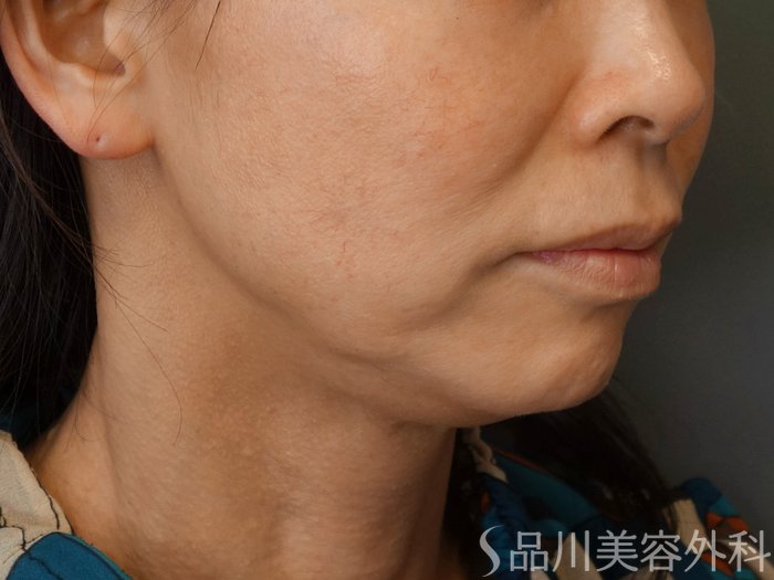 症例NO.72631のBEFORE写真