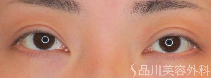 症例NO.64948のAFTER写真
