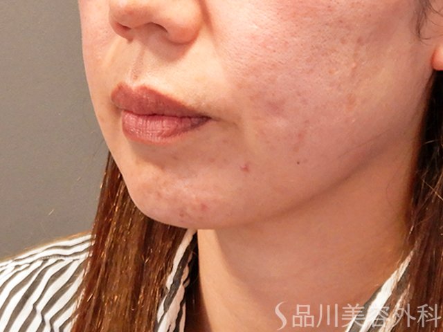 症例NO.69577のBEFORE写真