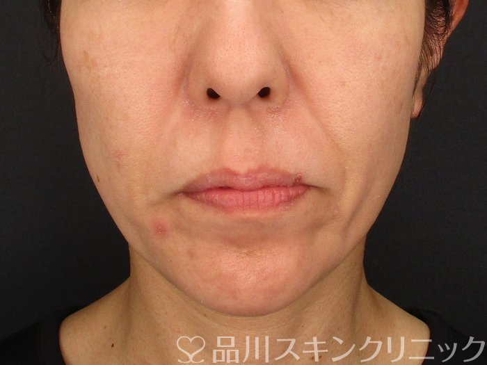 症例NO.67973のBEFORE写真