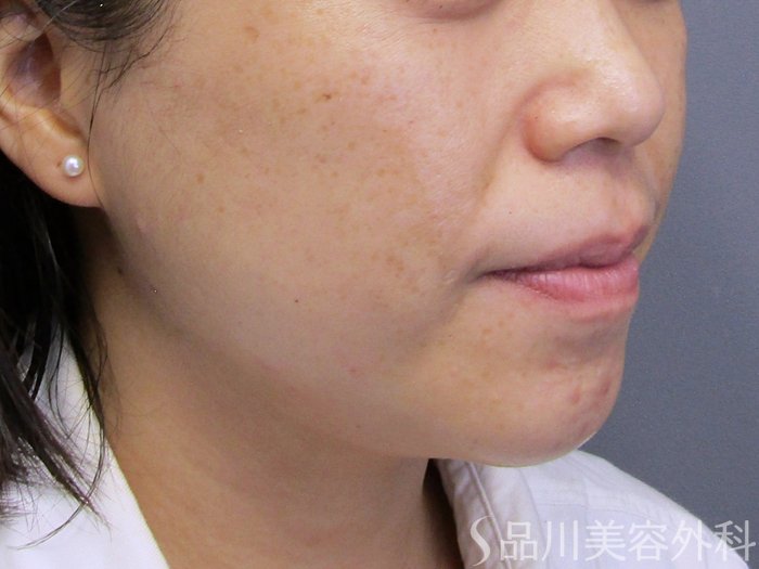 症例NO.74824のBEFORE写真