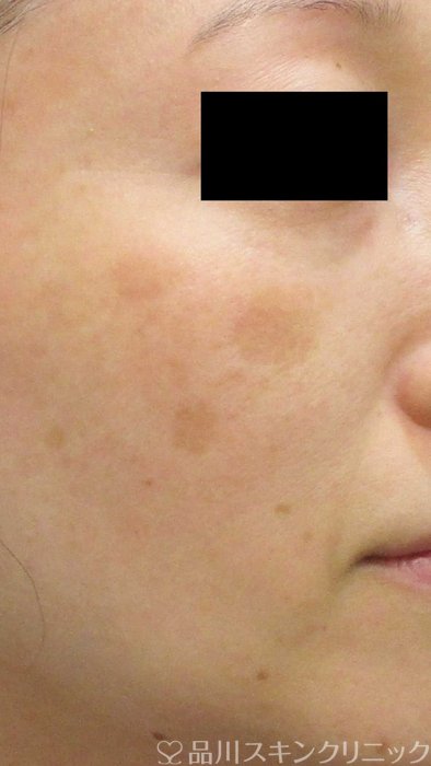 症例NO.64932のBEFORE写真