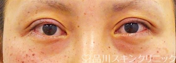 症例NO.49480のAFTER写真