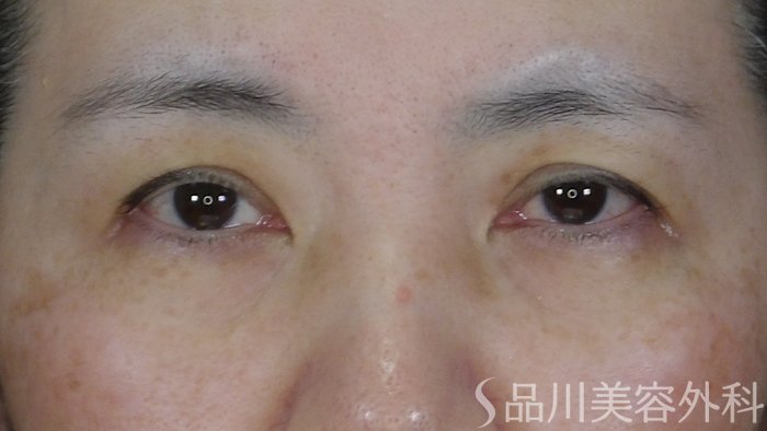 症例NO.70896のBEFORE写真