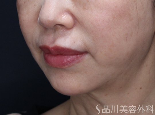 症例NO.72376のAFTER写真