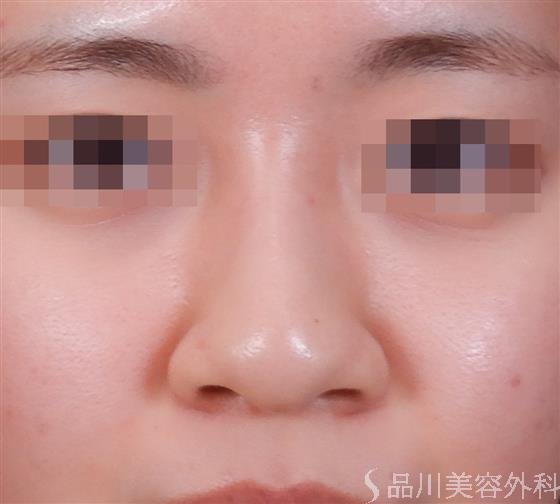 症例NO.58957のBEFORE写真