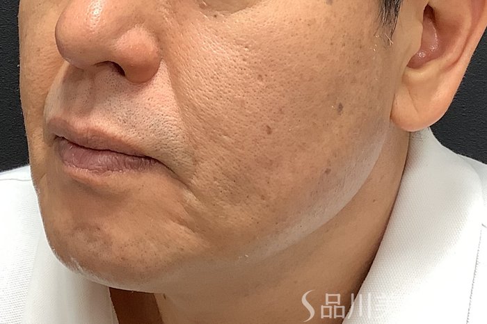症例NO.75305のBEFORE写真