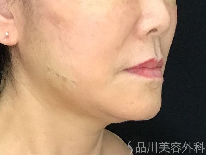 症例NO.71596のAFTER写真