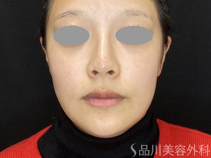 症例NO.72247のAFTER写真