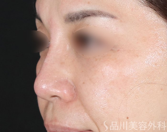 症例NO.73690のAFTER写真