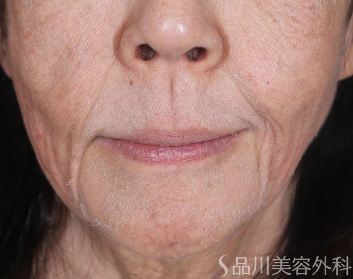 症例NO.73581のBEFORE写真