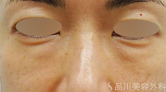 症例NO.49211のBEFORE写真