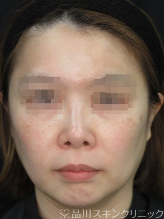 症例NO.73228のAFTER写真