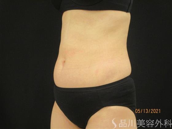 症例NO.51652のAFTER写真