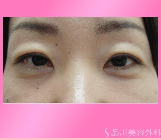 症例NO.4060のAFTER写真
