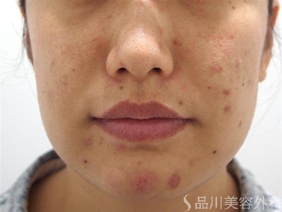 症例NO.21508のBEFORE写真