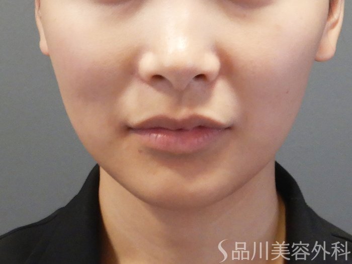 症例NO.71808のBEFORE写真